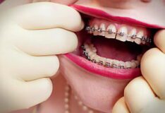 Corrida en cara brackets