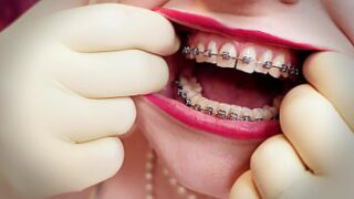 Corrida en cara brackets